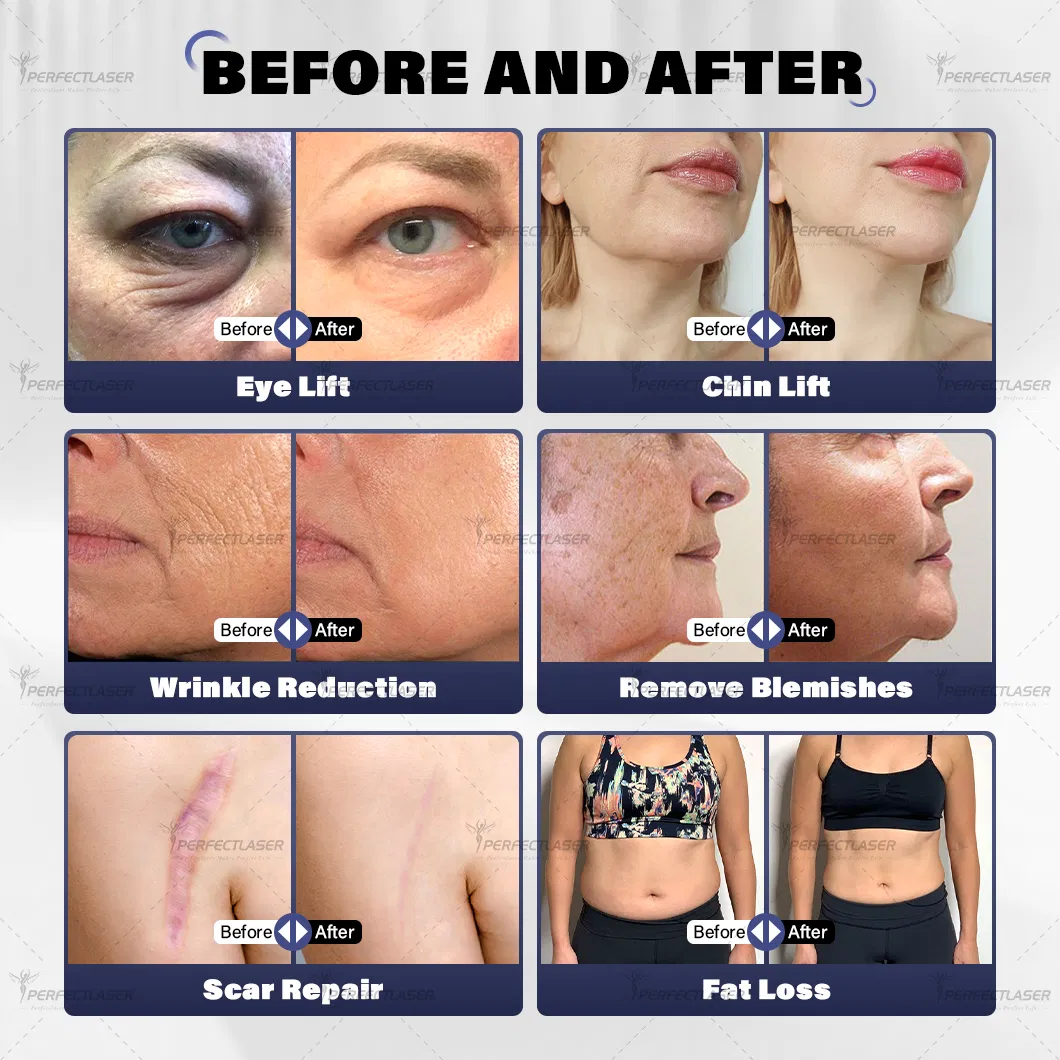 Hifu Before and After