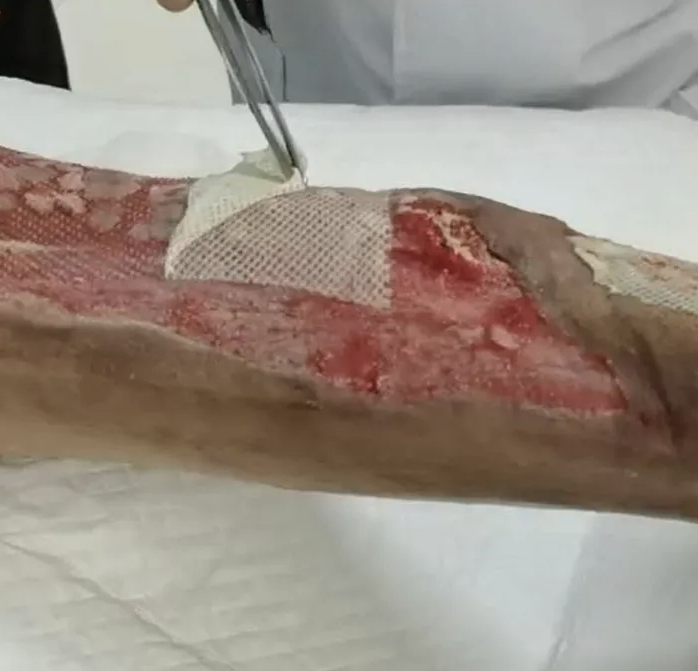 ضمادة جروح ألياف هلامية سيليكون معقمة ضمادة جروح ألياف هلامية سيليكون معقمة ضمادة جروح ألياف هلامية سيليكون معقمة هلام سيليكون معقم
