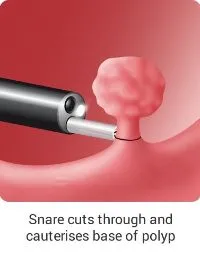 Endoscopic Consumables 2