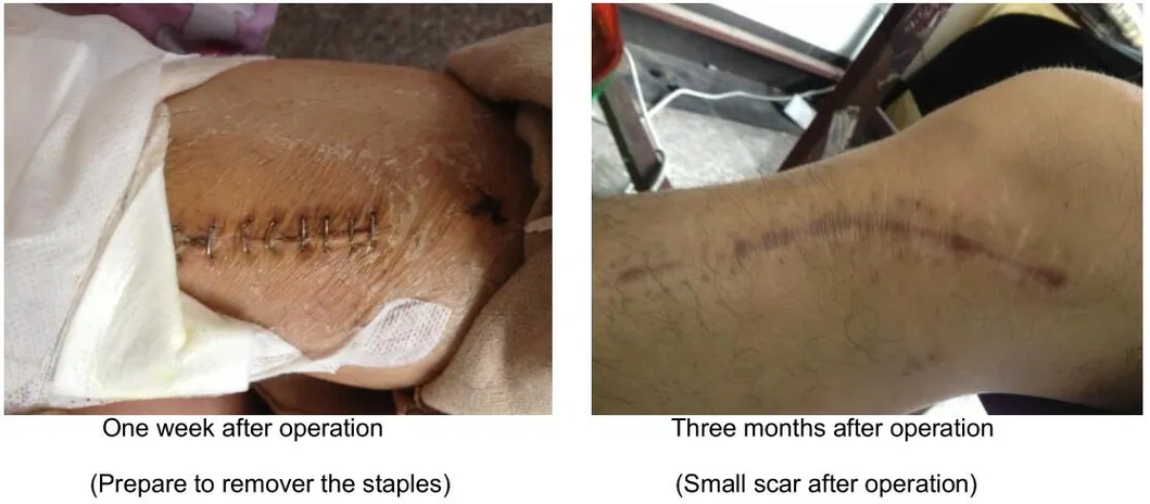 Postoperative Effect