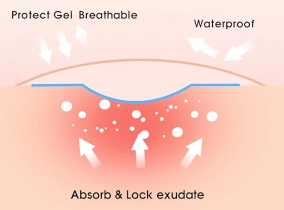 Why use Hydrocolloid
