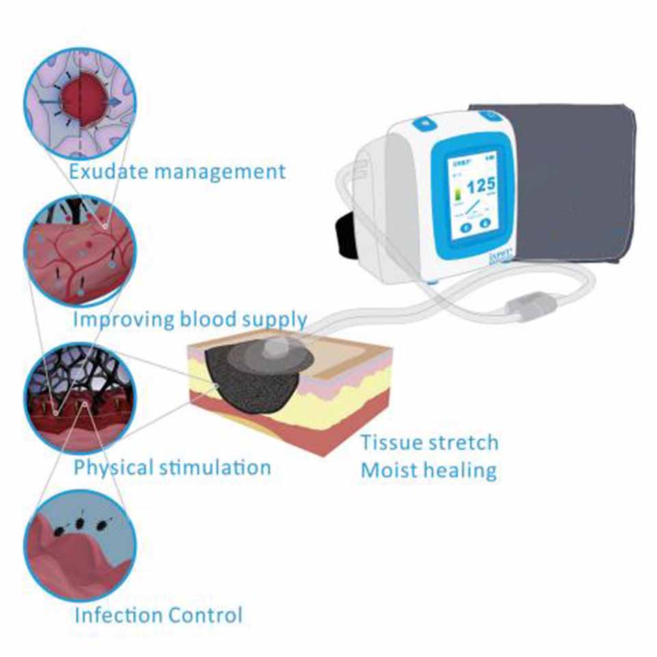 Negative Pressure Wound Therapy System Npwt with Dressing Medical Devices Equipment