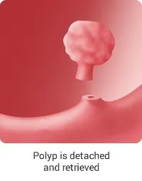 Endoscopic Consumables 3