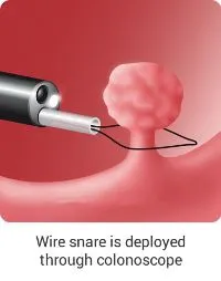 Endoscopic Consumables 1
