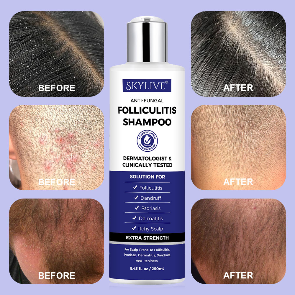 New Arrivals Hair Care Organic Deep Cleansing Shampoo for Revitalizes Scalp Psoriasis Anti-Fungal Shampoo for Folliculitis