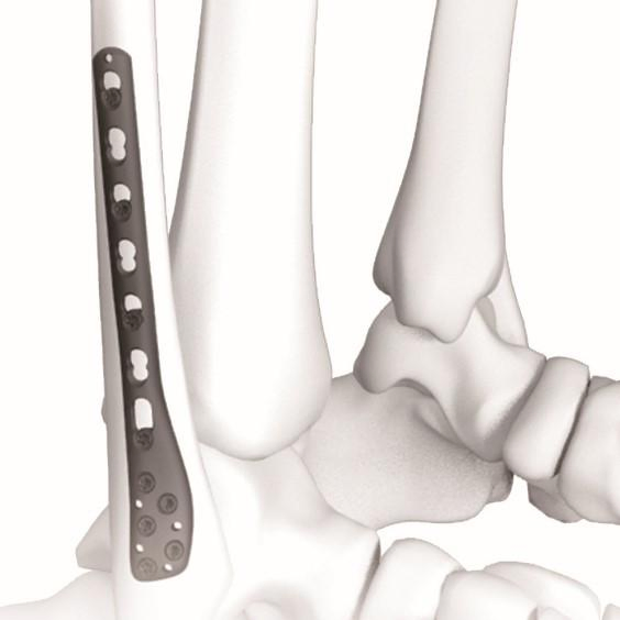 Canwell Orthopedic Titanium Distal Fibular Fracture Locking Plate, Osteosynthesis Fibula Plate