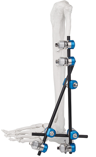 Titanium Alloy Femur Fixator for Bone Alignment