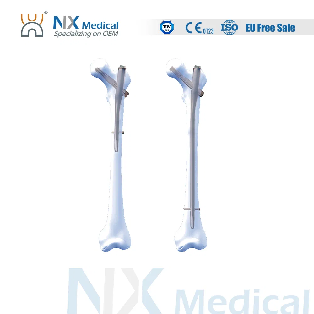 Nx Medical Orthopedic Trauma Titanium Intramedullary Interlocking Femoral Femur Pfna Bone Nail