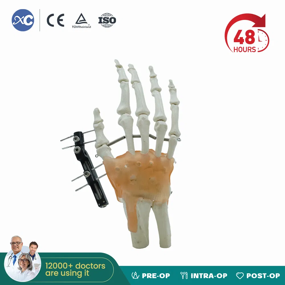 High Quality Mini Fragment External Fixator Orthopedic Medical Metacarpals External Fixation