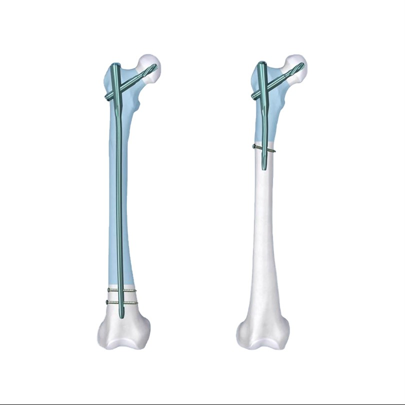 Orthopedic PFNA Femoral Implant PFN Proximal Femur Intramedullary Interlocking Nail