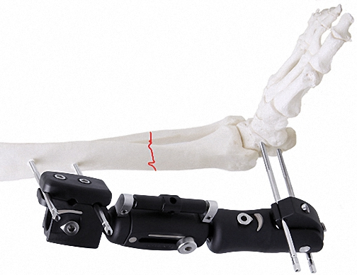 Reliable External Fixator for Bone Fixation, White &amp; Black, Stainless Steel