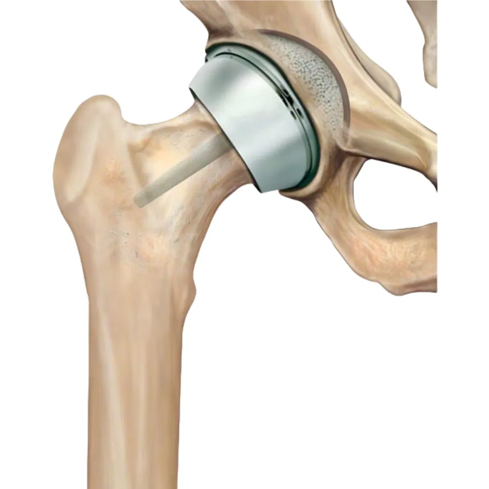 Cocrmo Alloy Total Knee Replacement Investment Casting for Medical Hip Implants