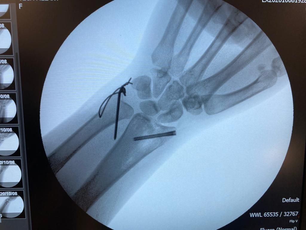 Headless Cannulated Compression Screw, Titanium Orthopedic Locking Screw Implant Medical Mini Bone