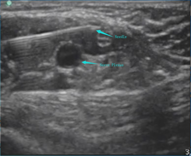 Advanced Custom Nerve Block Needle for Professional Medical Use