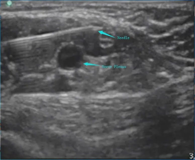 Nerve Block Needle Detail 7