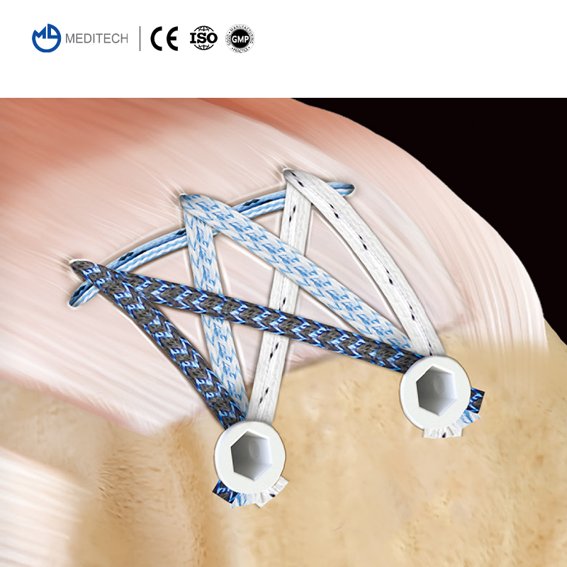 Sports Medicine All-Suture Anchor Absorbable Knotless Suture Anchor Surgical Sutures Knee Arthroscopy All Inside Meniscus Repair