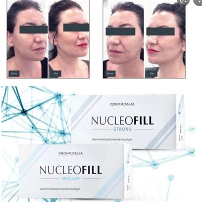 Injectable Hyaluronic Aicd Nucleofill Strong Face Lifting Winkle Removal Ibsa Profhilo H+L Essence