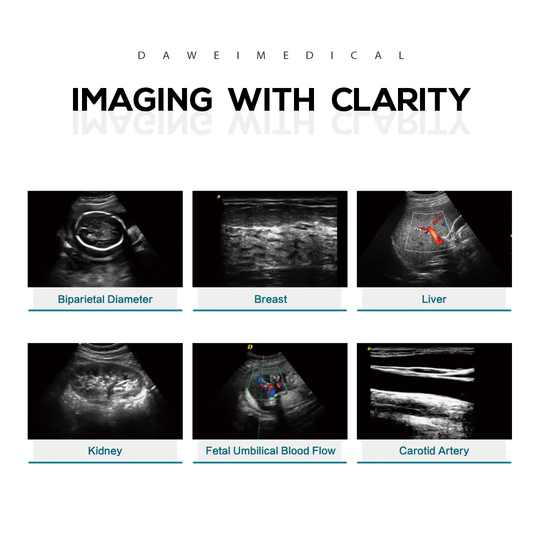Mobile Cart Trolley 2D Carotid Artery Vascular Doppler Ultrasound Scanner