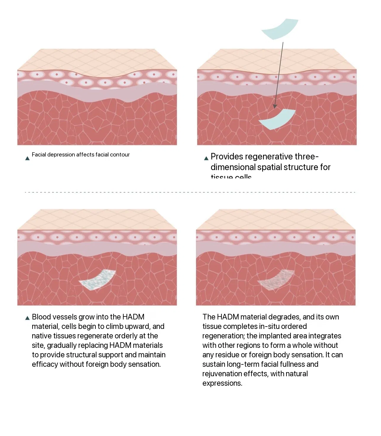 Hadm Long-Acting Collagen Biological Scaffold, Medical Device