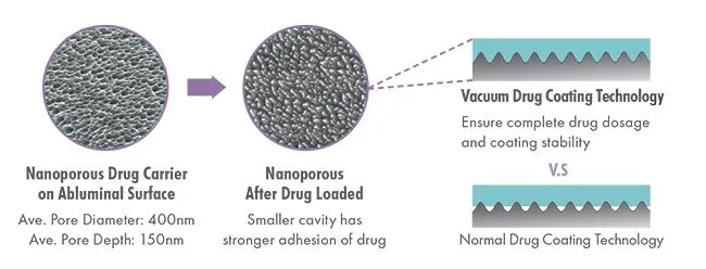 Stent System Overview