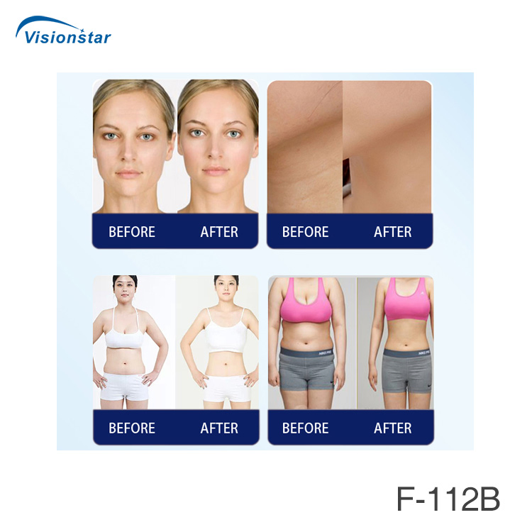 Vso-112b Hifu Face Lifting Portable Facial Machine