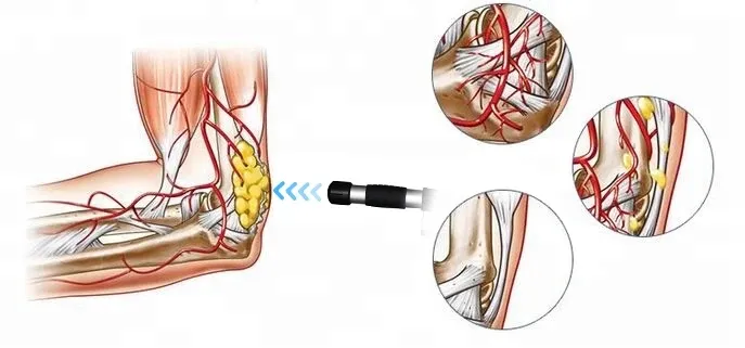Shockwave Therapy Machine View 3