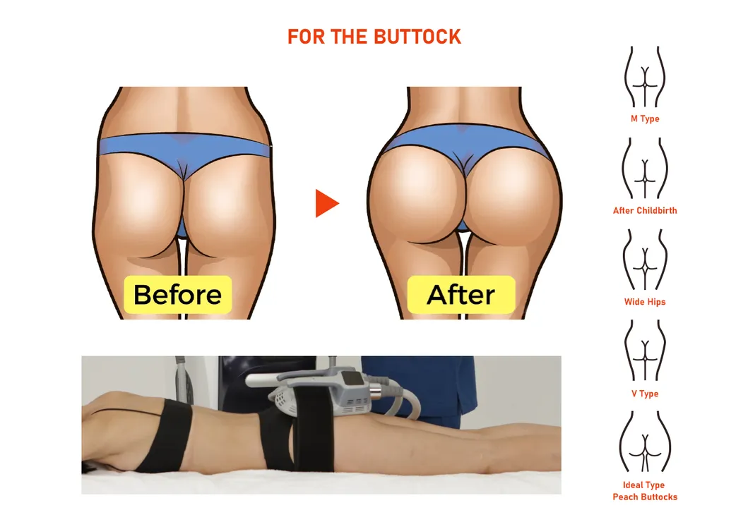 Butt Lift Procedure 2