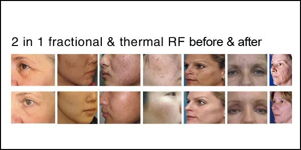 RF Treatment Results