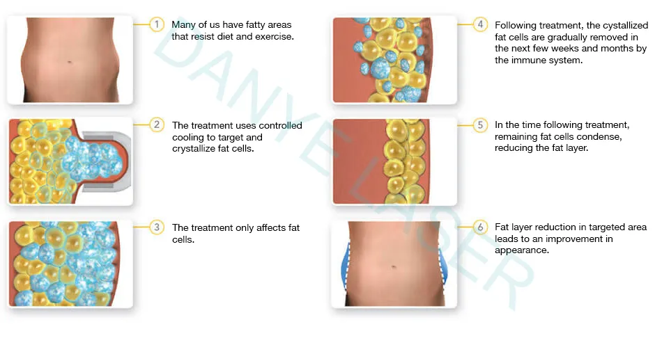 Cryolipolysis Principle
