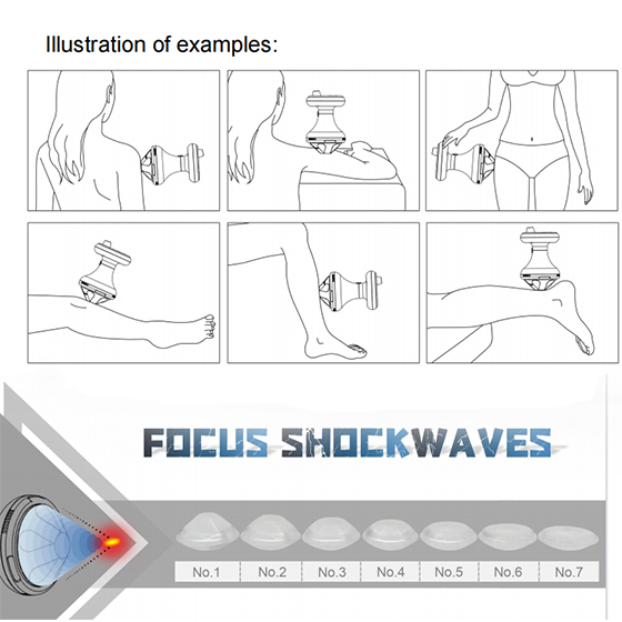 Physiotherapy Physical Rehabilitation Focal Focus Focused Shockwave Electromagnetic Ondas De Choque Shock Wave Therapy Eswt ED Erectile Dysfunction Machine
