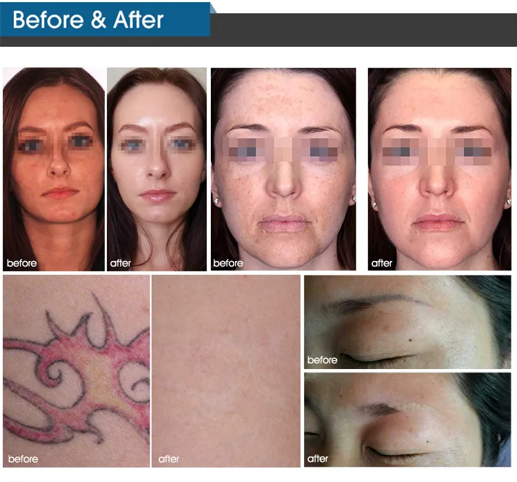 Before and After Results