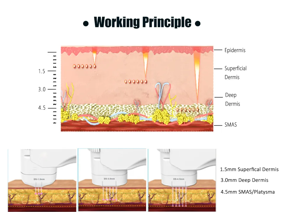 Treatment areas