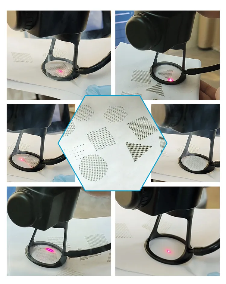 Fractional CO2 Laser