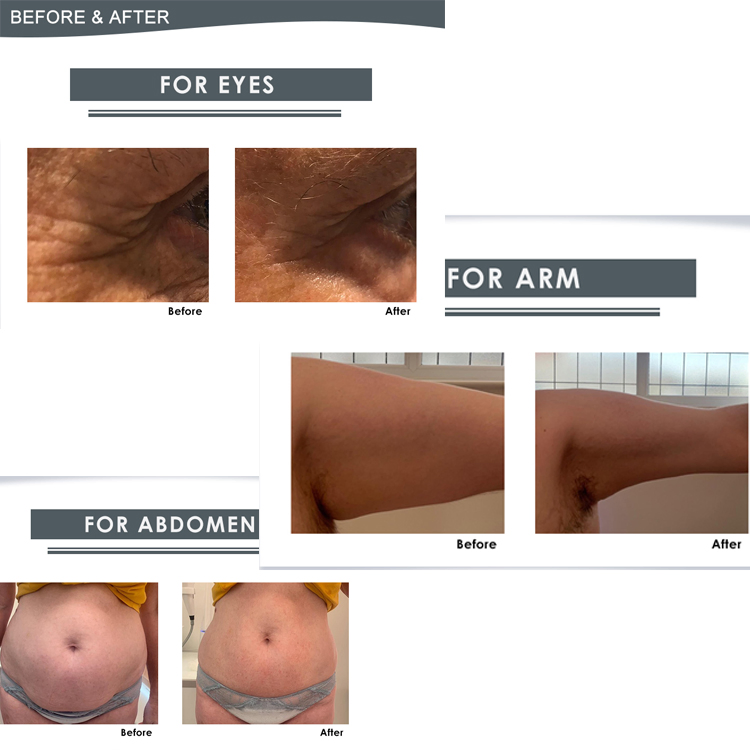 Factory Price 7D Hifu Machine Wrinkle Removal Face Lifting 3D 4D 5D Hifu High Intensity Focused Ultrasound Vaginal Rejuvenation