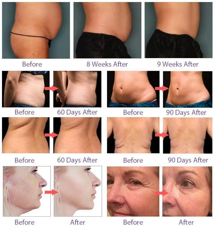 Portable 4D Hifu Machine for Face Lifting and Skin Tightening