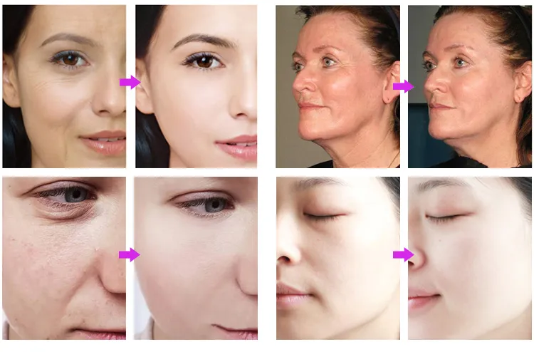 Before and After Results