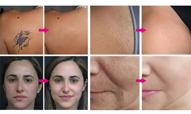 Before and After Results