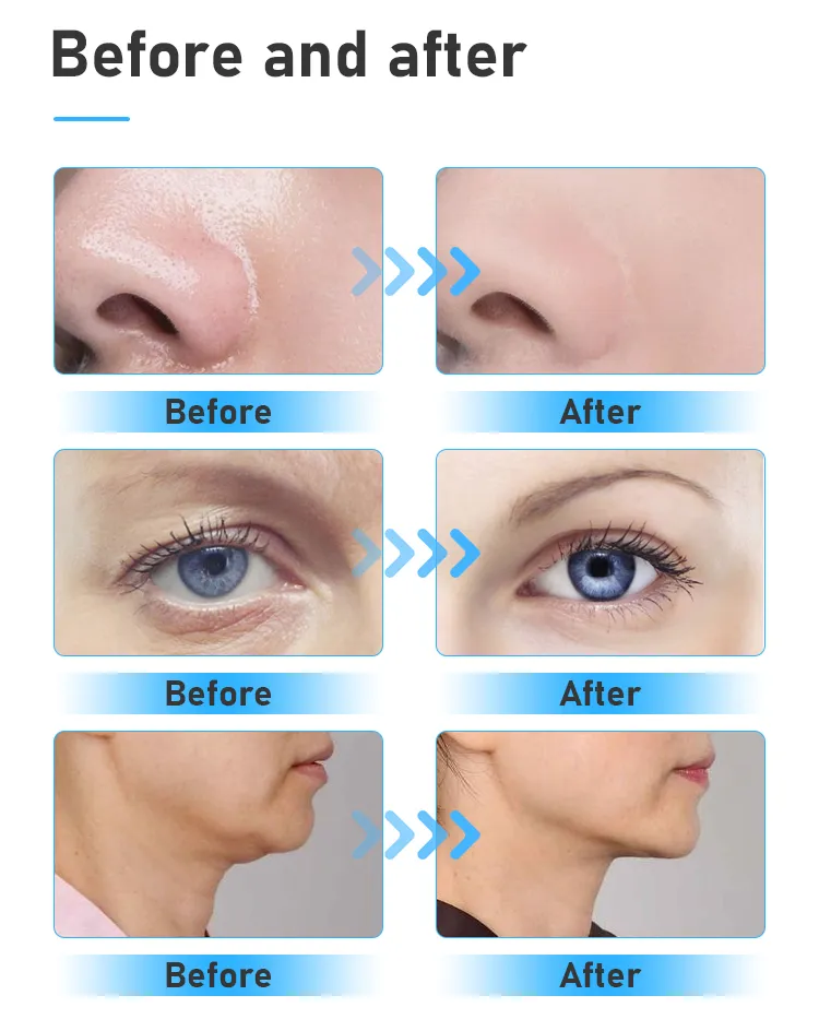 Before and After