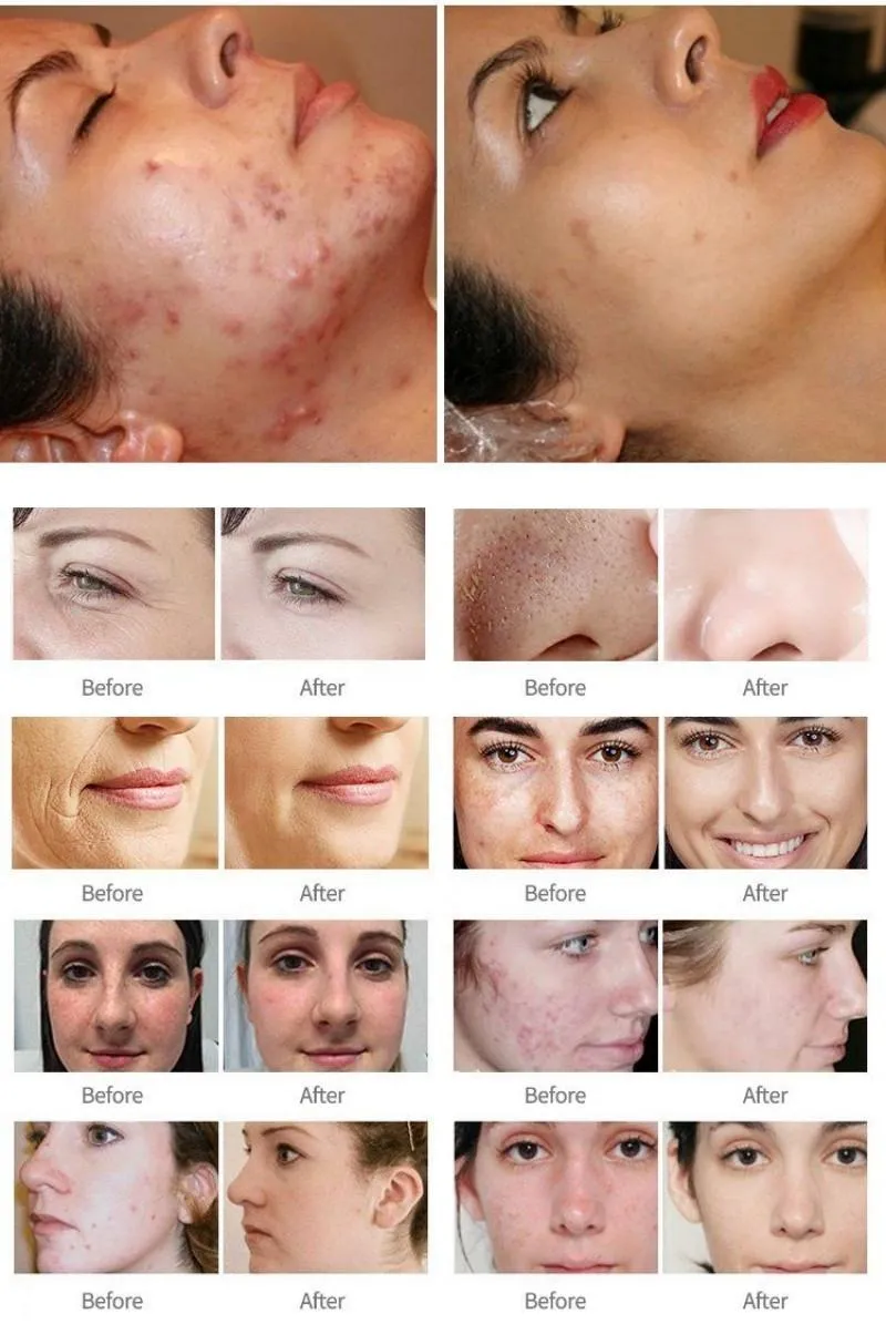 Before and After