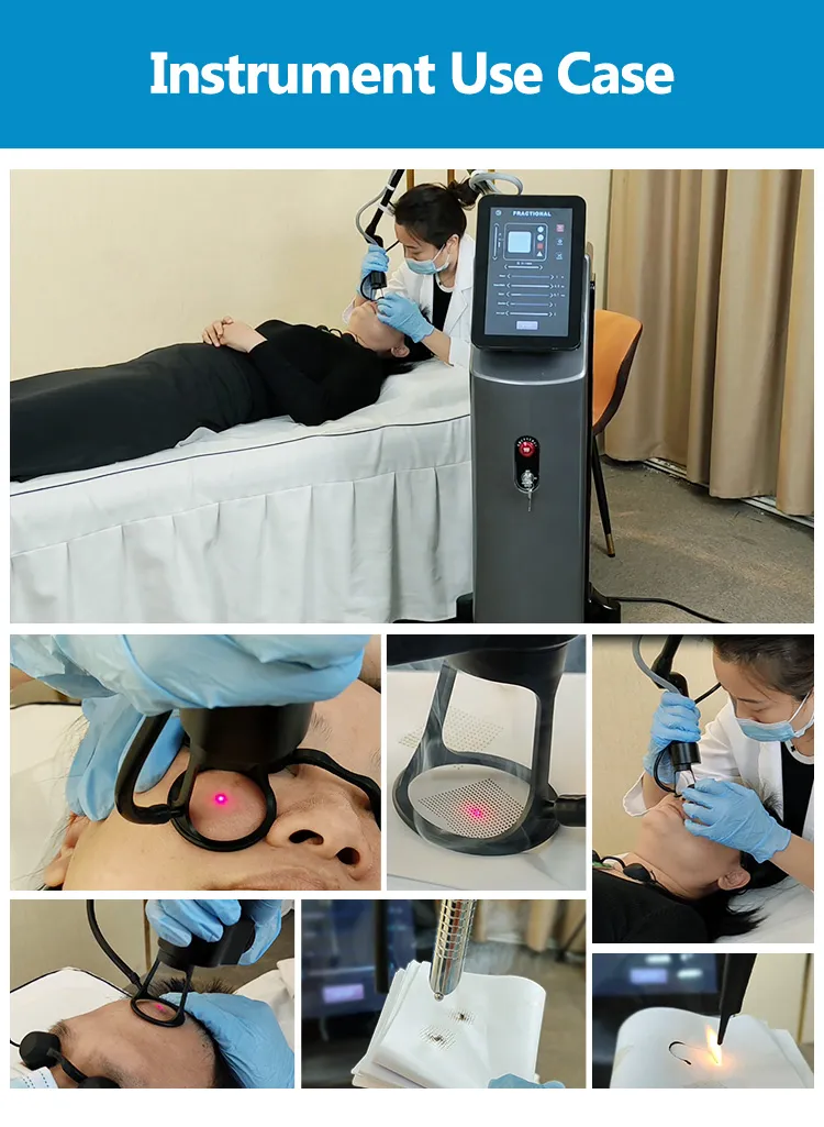 Fractional CO2 Laser