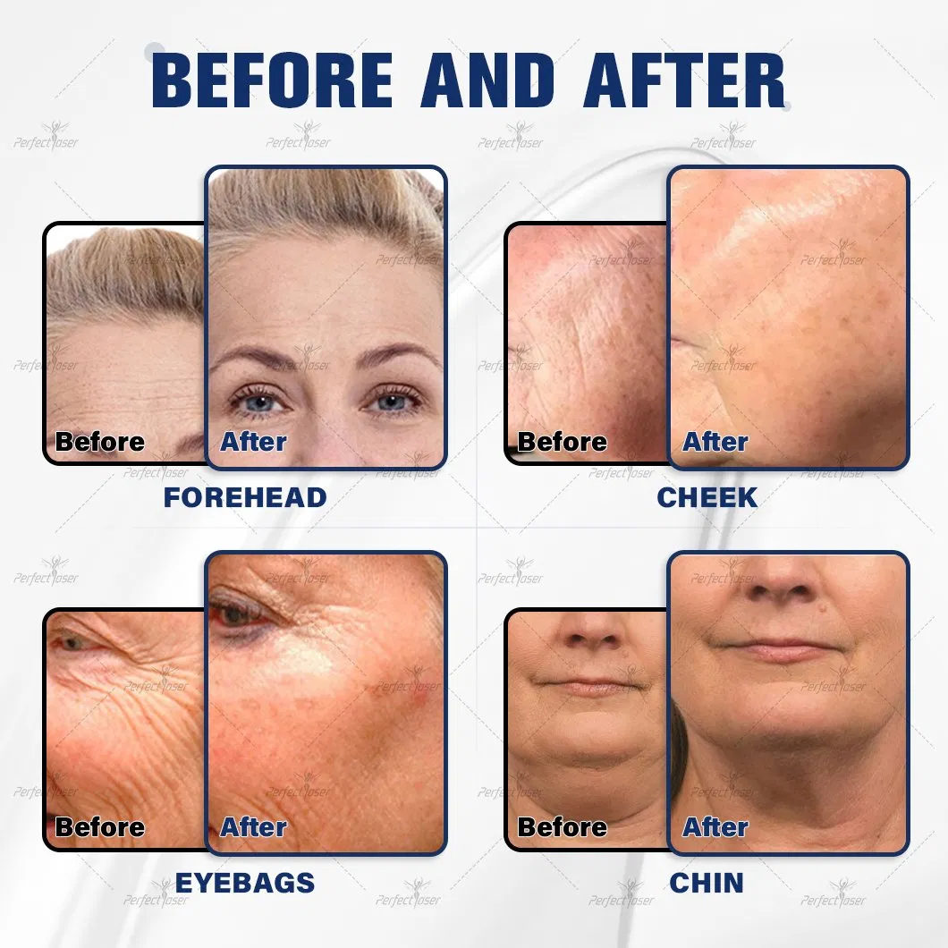 Time-Efficient PE-Facial Emfacings Skin Tightening Lifting Multipole RF EMS Device