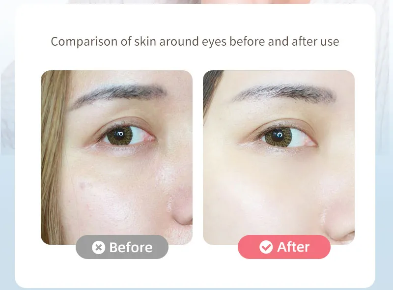RF Beauty Device 11