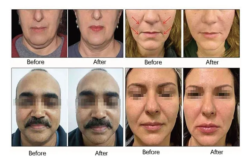 Before and After 1