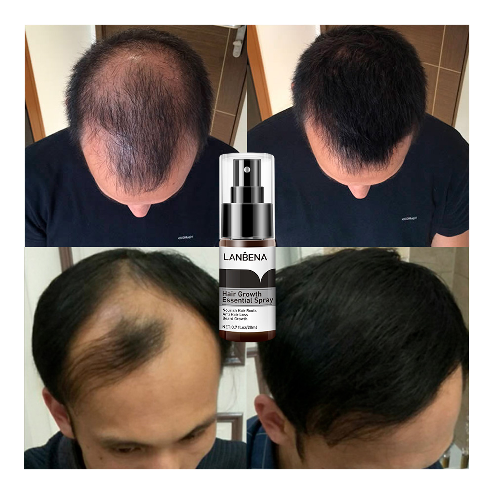 LANBENA Herbal Instant Hair Grow Spray Hair Treatment Growth Women Wholesale