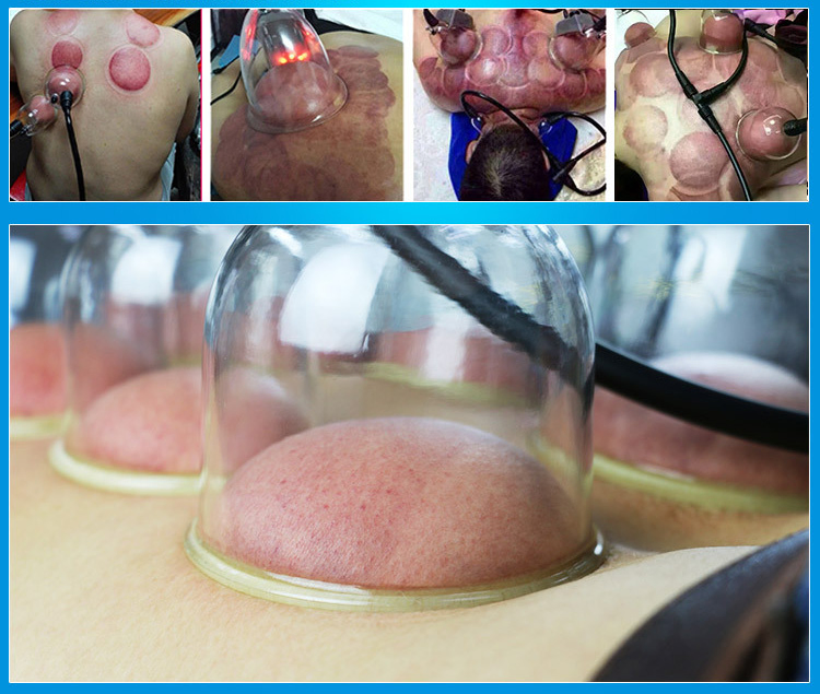 Multifunctional Vacuum Therapy Device for Cupping Health Scraping Lymphatic Drainage and Breast Maintenance Professional Beauty Salon Machine