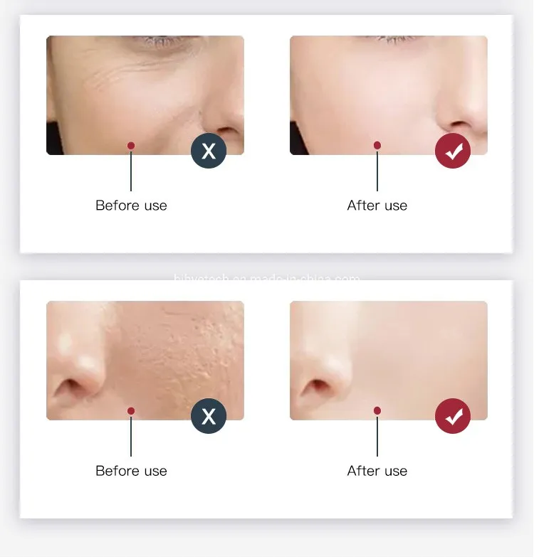 Phototherapy Results