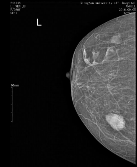 Advanced Digital Breast Imaging System for Rapid Diagnosis of Breast Conditions