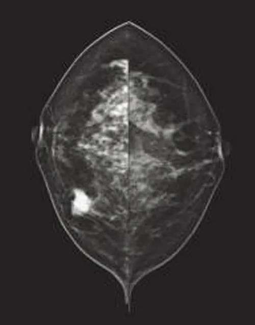 Advanced Digital Breast Imaging System for Rapid Diagnosis of Breast Conditions