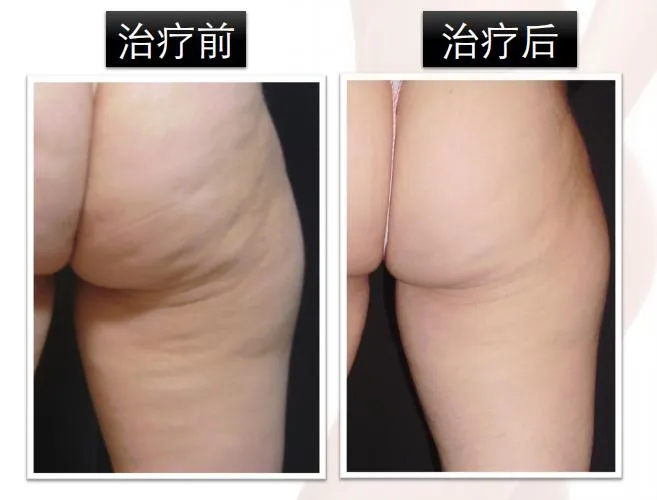 Treatment Application 2