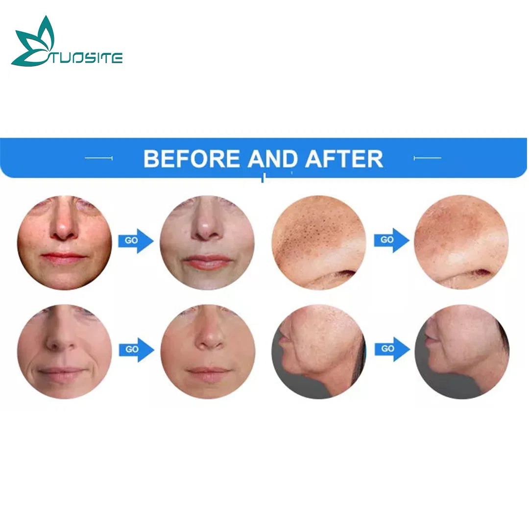 Advanced Skin Beauty Equipment for Oxygen Infusion Therapy